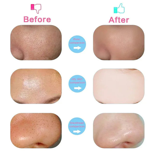 Deep Cleansing, Exfoliating & Blackhead Remover Tool 💆‍♀️✨