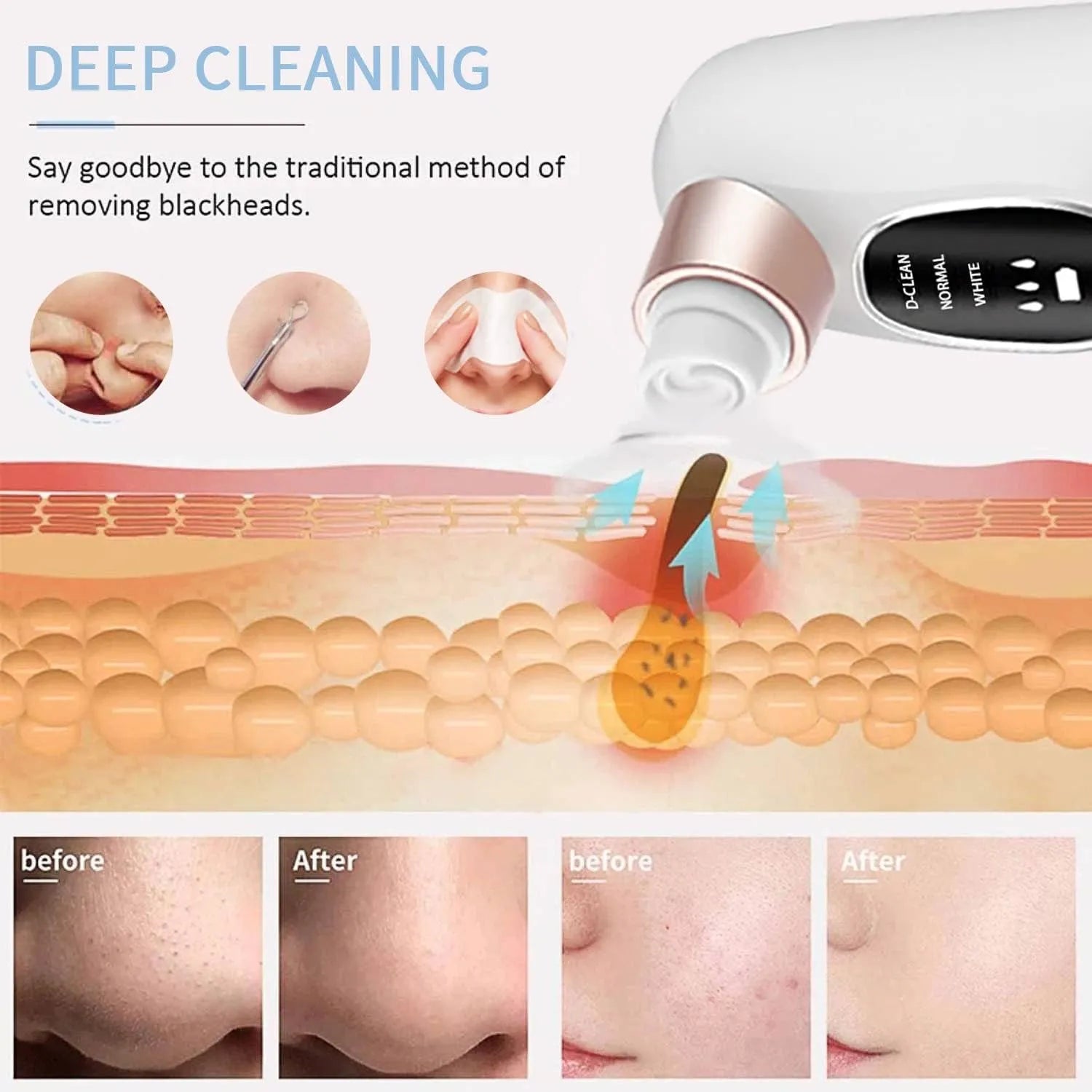 🌸✨ Blackhead Remover – Clear Skin in Minutes 💖🧖‍♀️